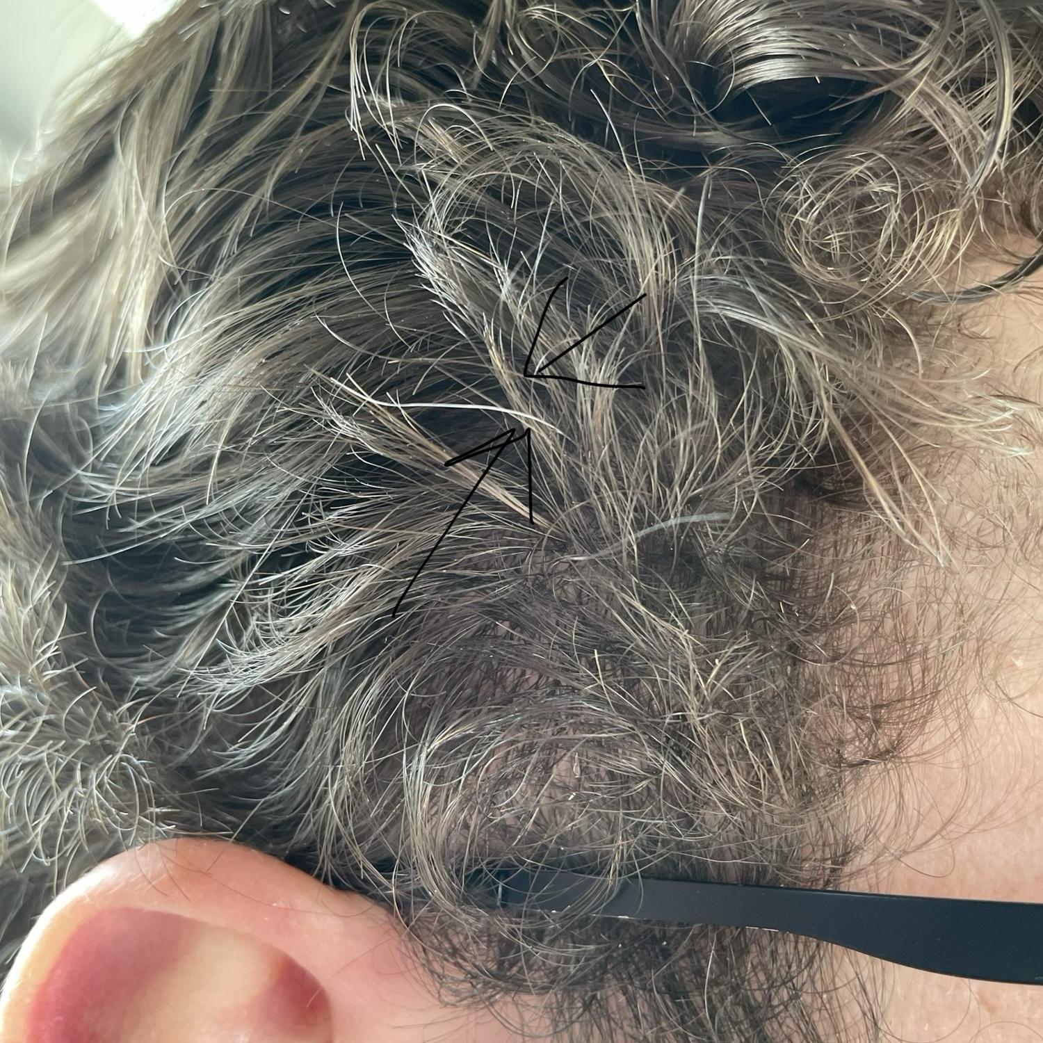 Dane’s first gray hair, a direct result of the stress he felt while dating Alenda