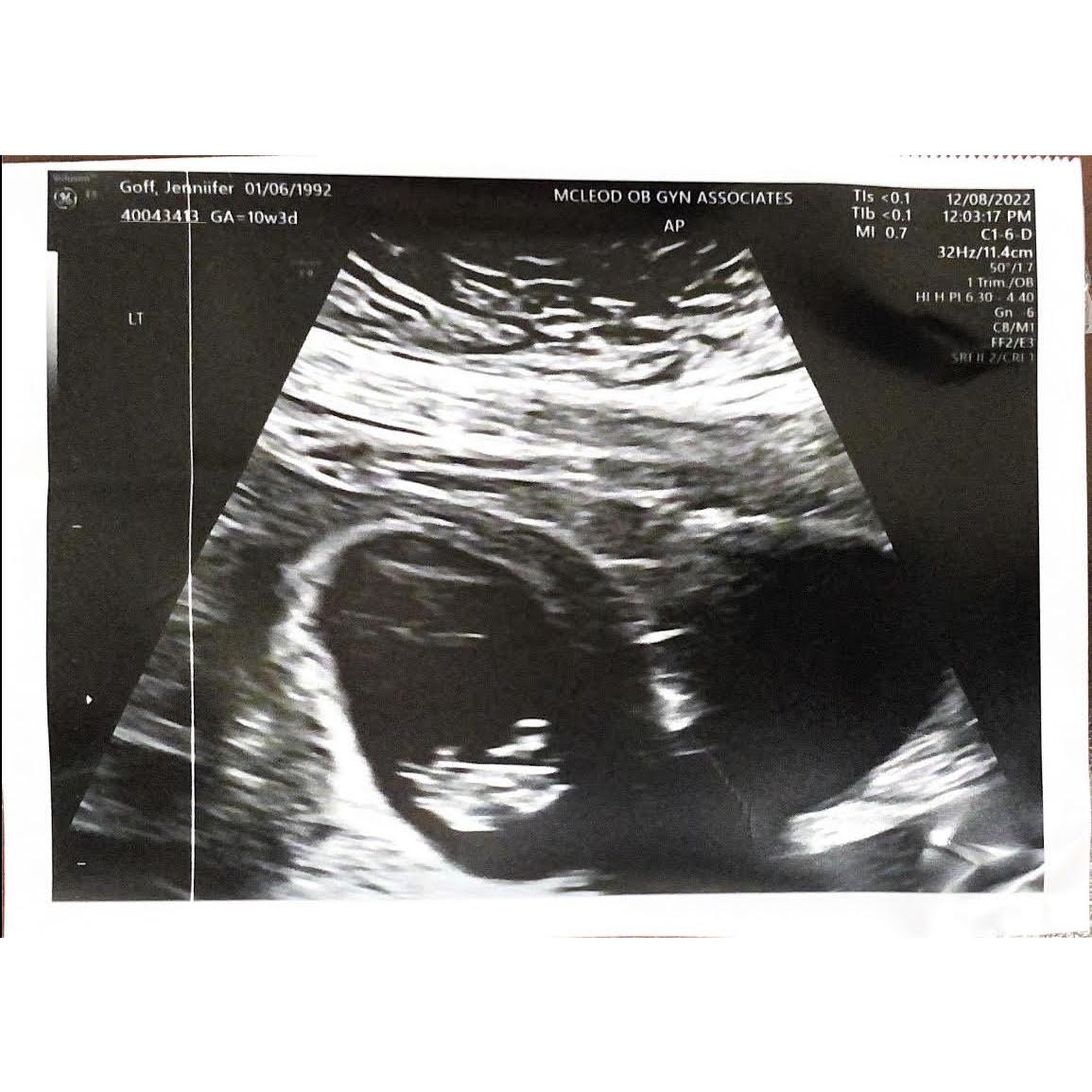 9 Week Ultrasound