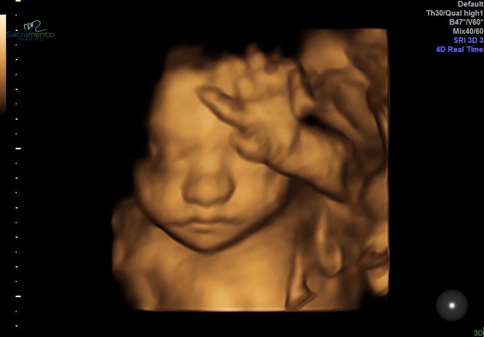 Our first 3D image of our baby girl 🥰