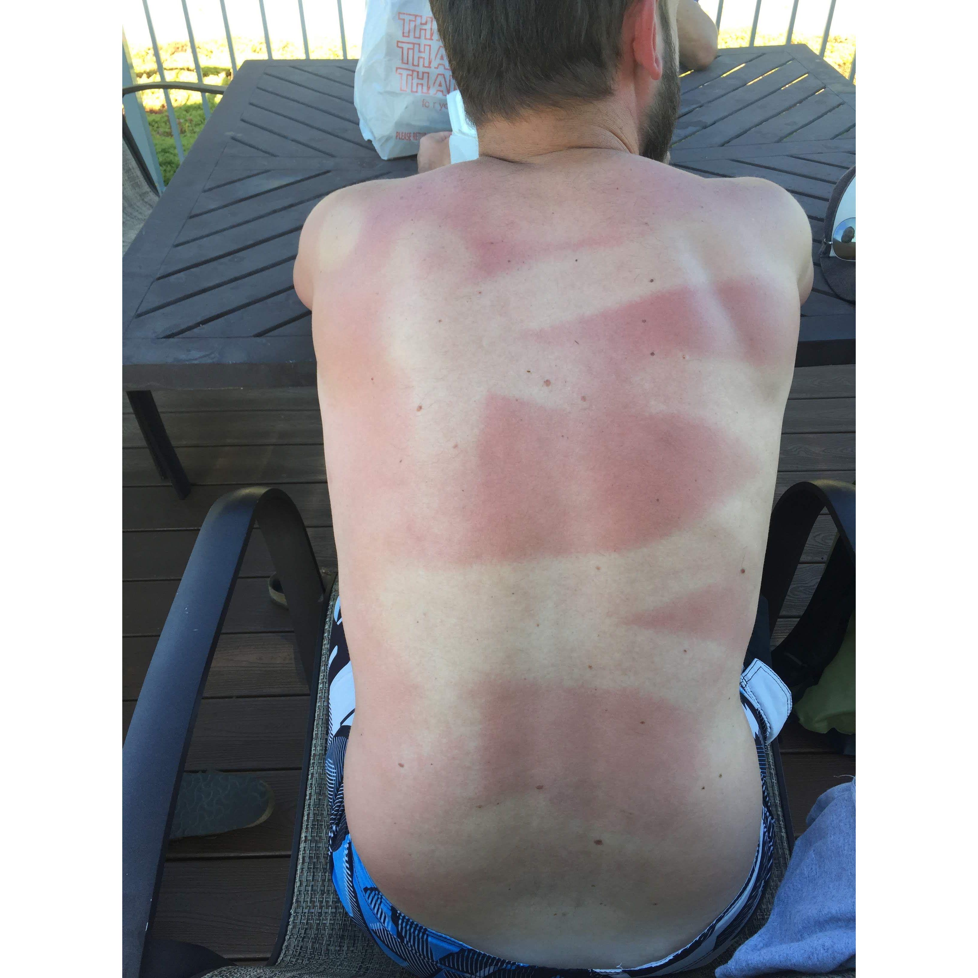 The really good sunscreen job I did on Peters back…