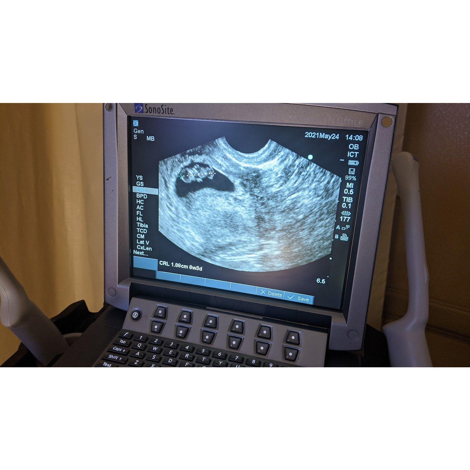 Primer Ultra Sonido de Octavio Jr.