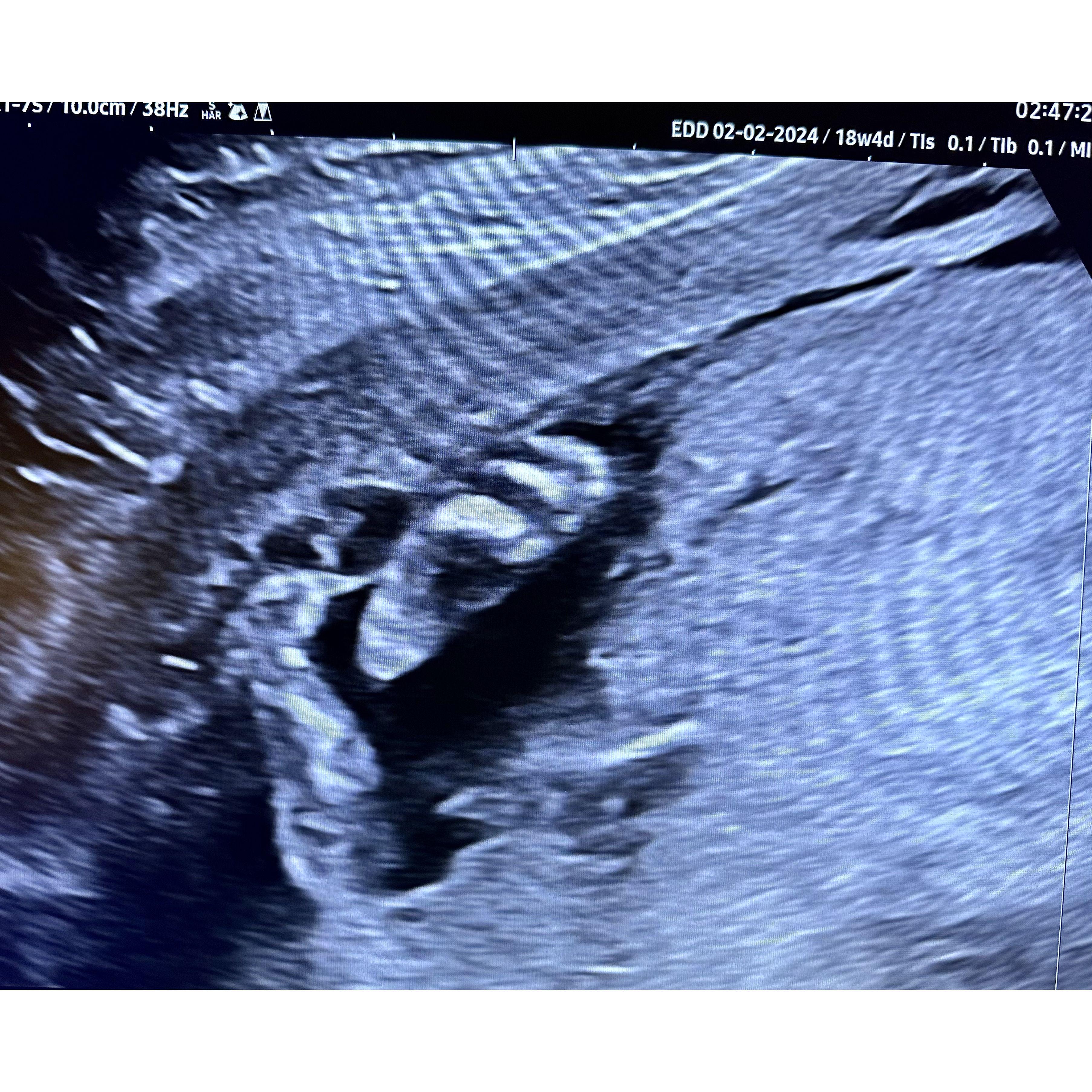 Baby foot