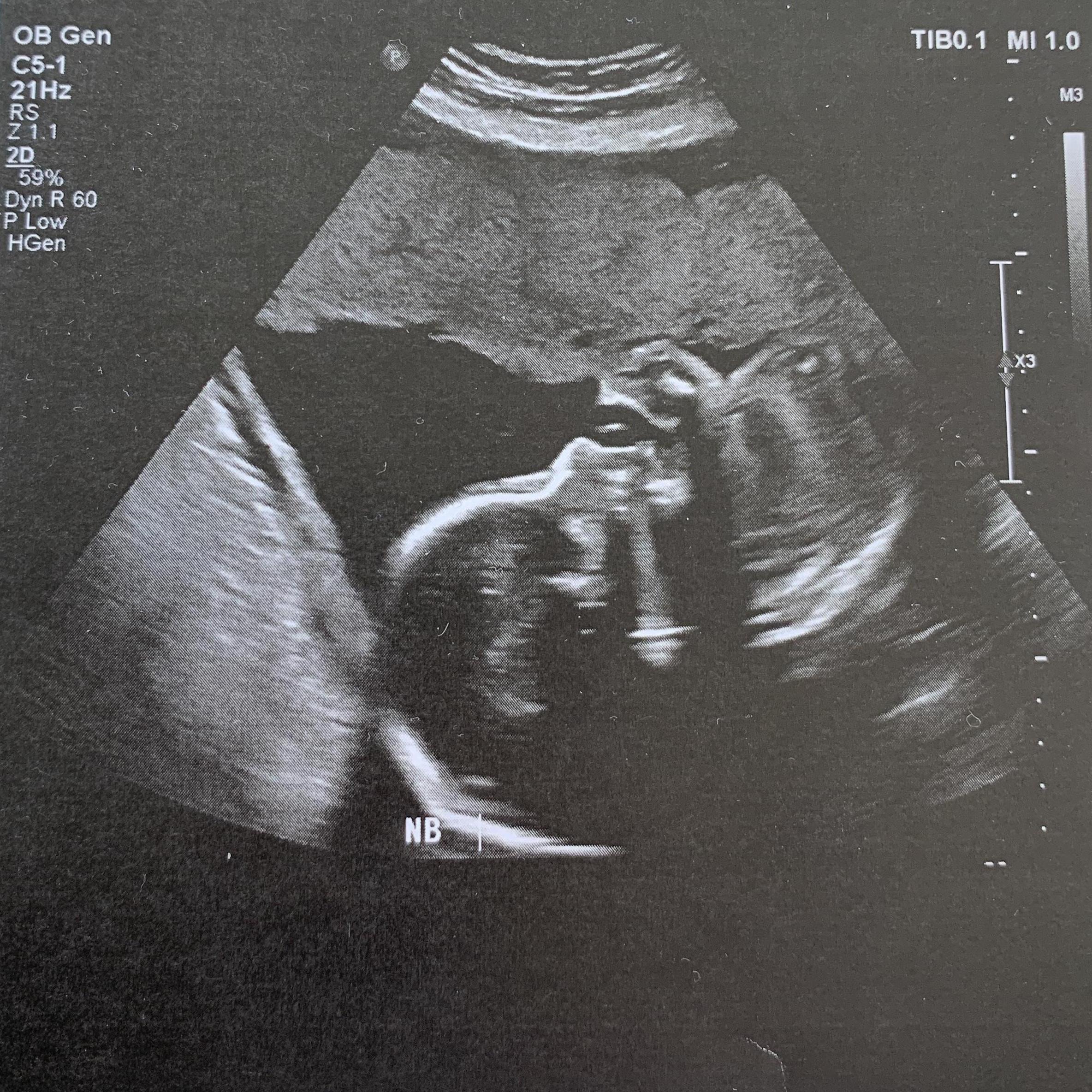 25 weeks!