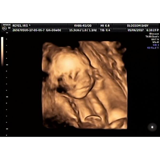 Primer Ultra Sonido de Sophia 2017