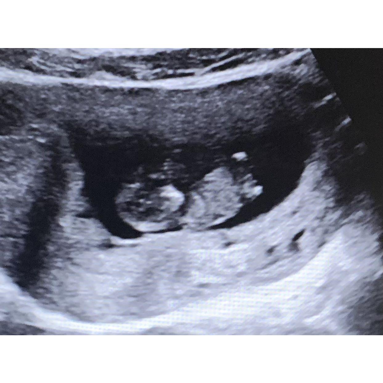 Our first ultrasound ❤️ September 2022