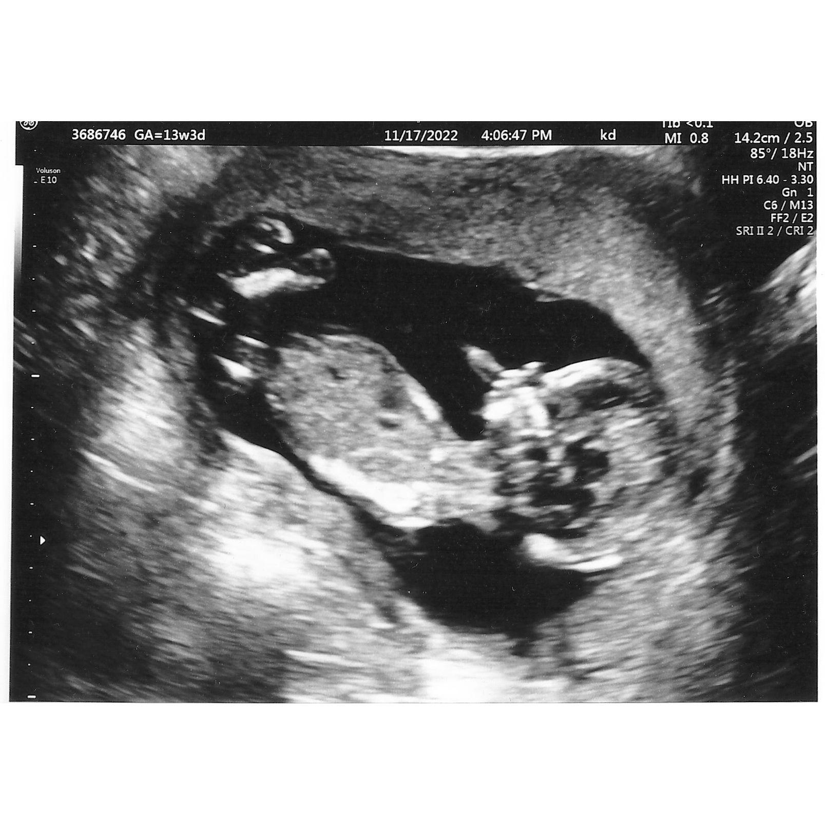 Our first full ultrasound at 17 weeks :)