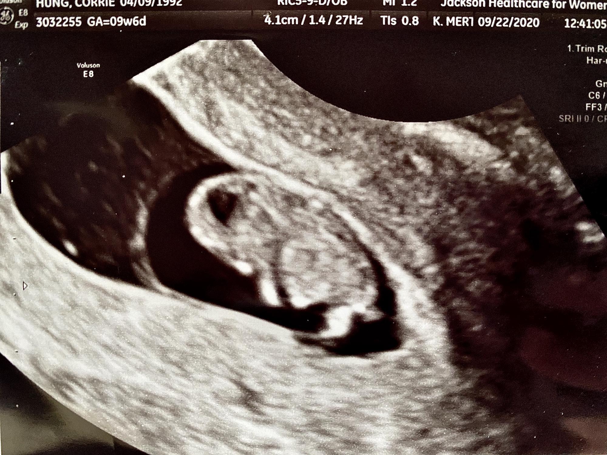 Our sweet little miracle