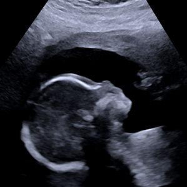 Baby Bonner Fund