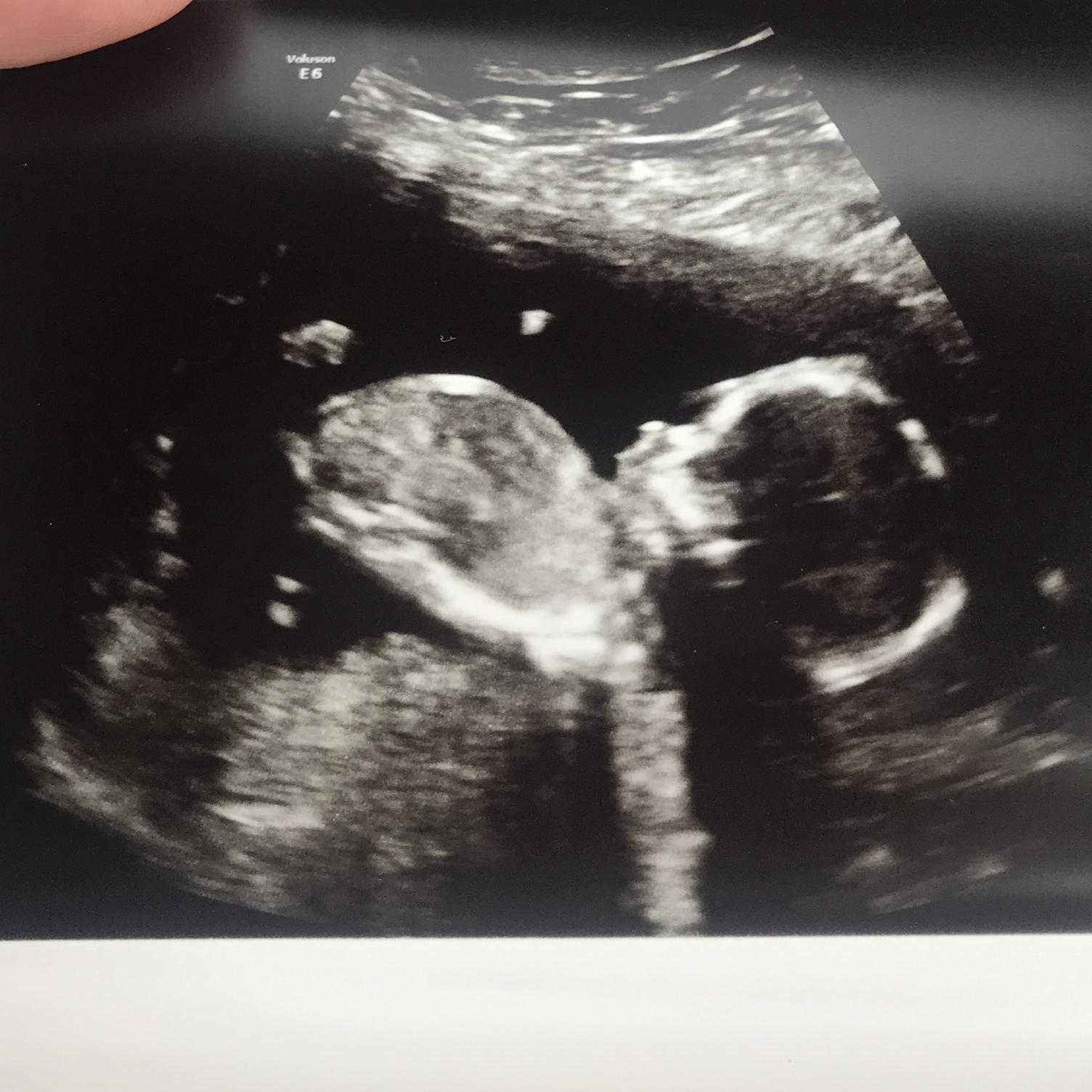 Our little pumpkins’ ultrasound! We love her so much!