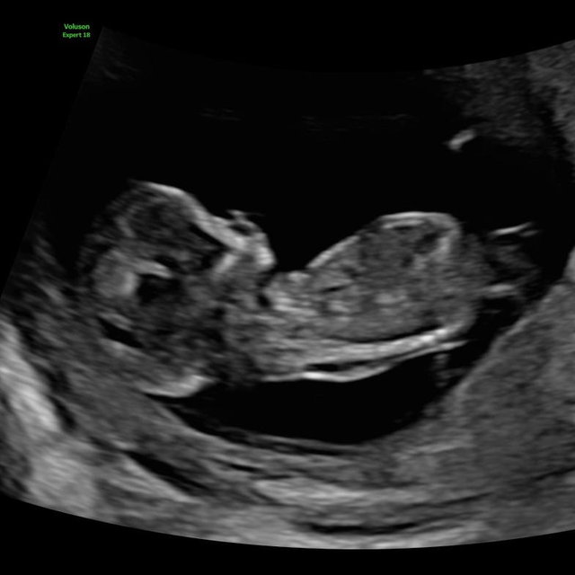 Baby Hebert