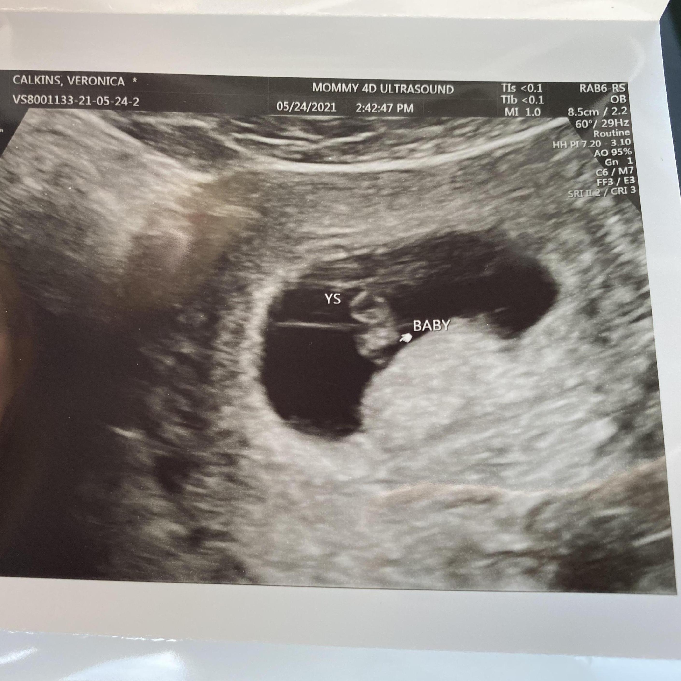 One more of Baby Flatow first picture!