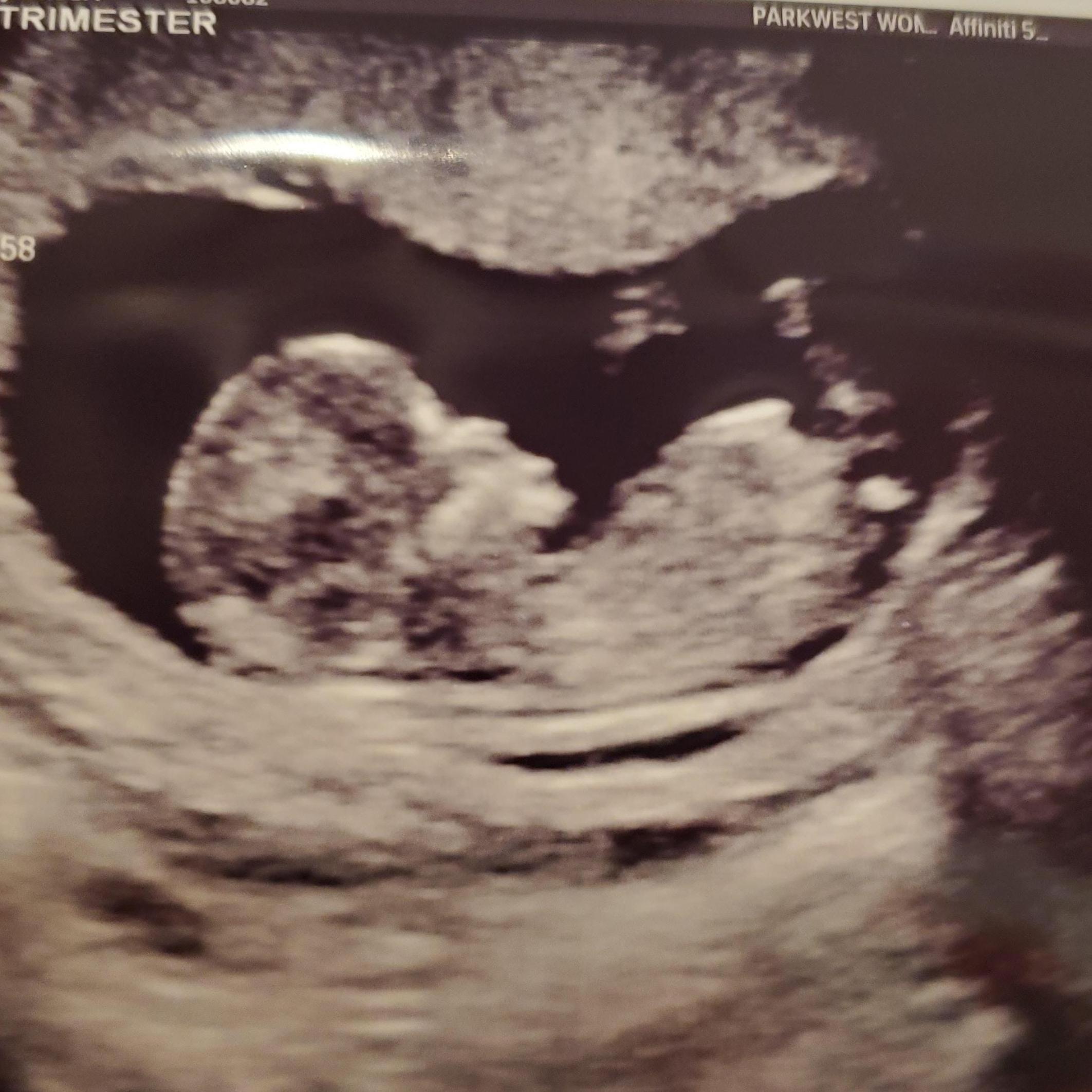 12 week ultrasound!