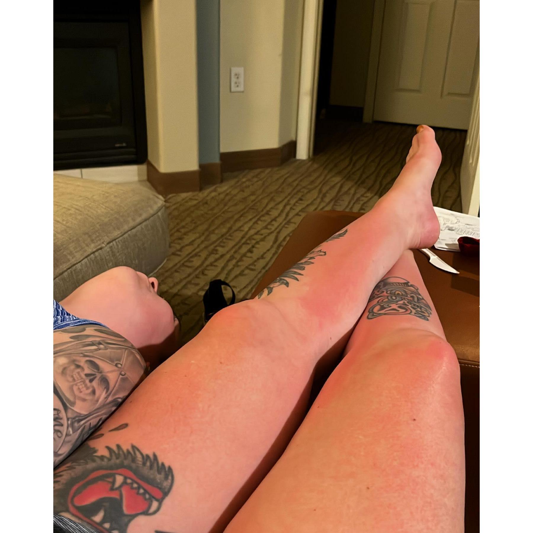 Very sunburnt together.