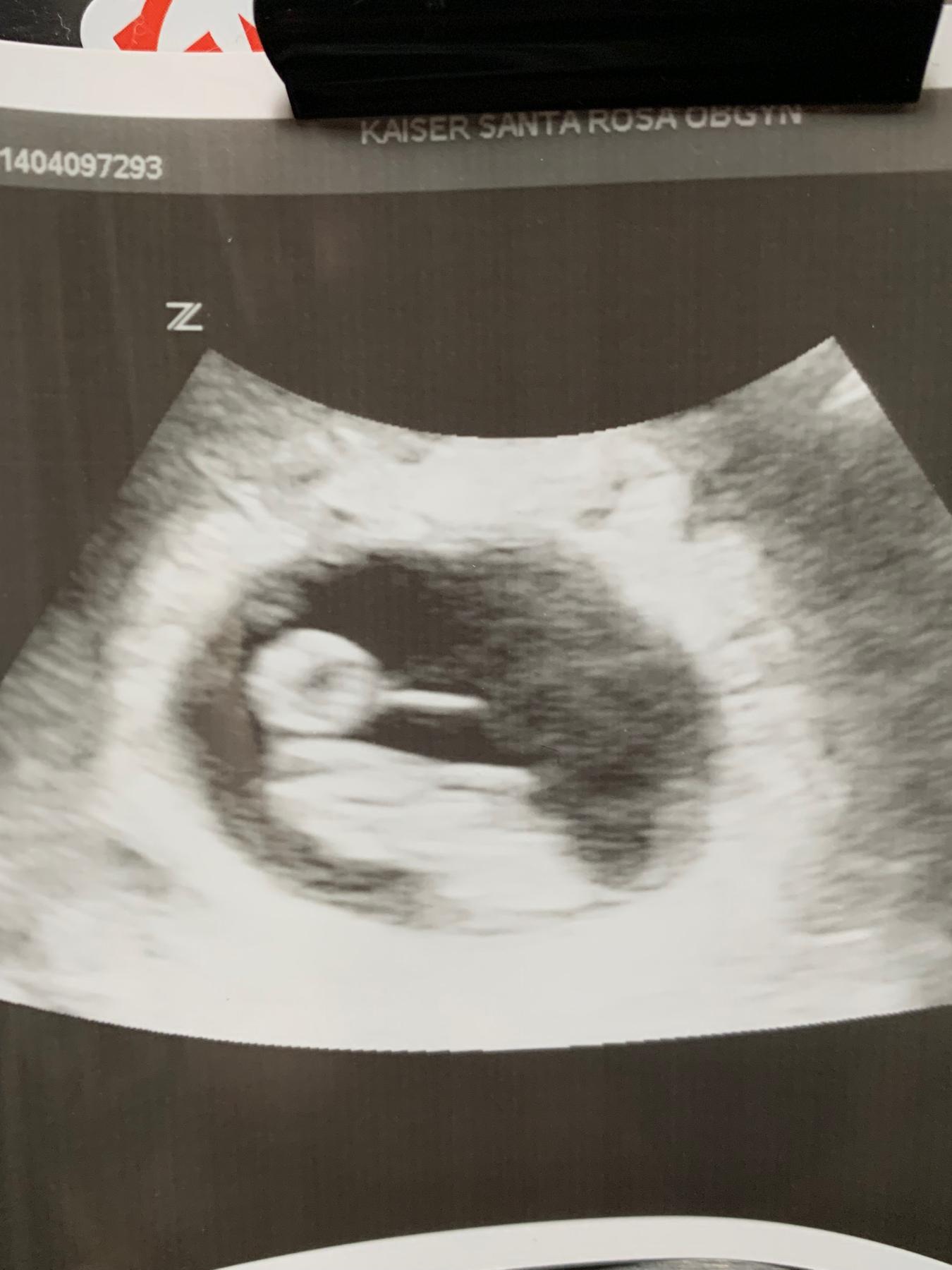 Our first picture of our future family member! Can you see why we dubbed them “Duckie”?