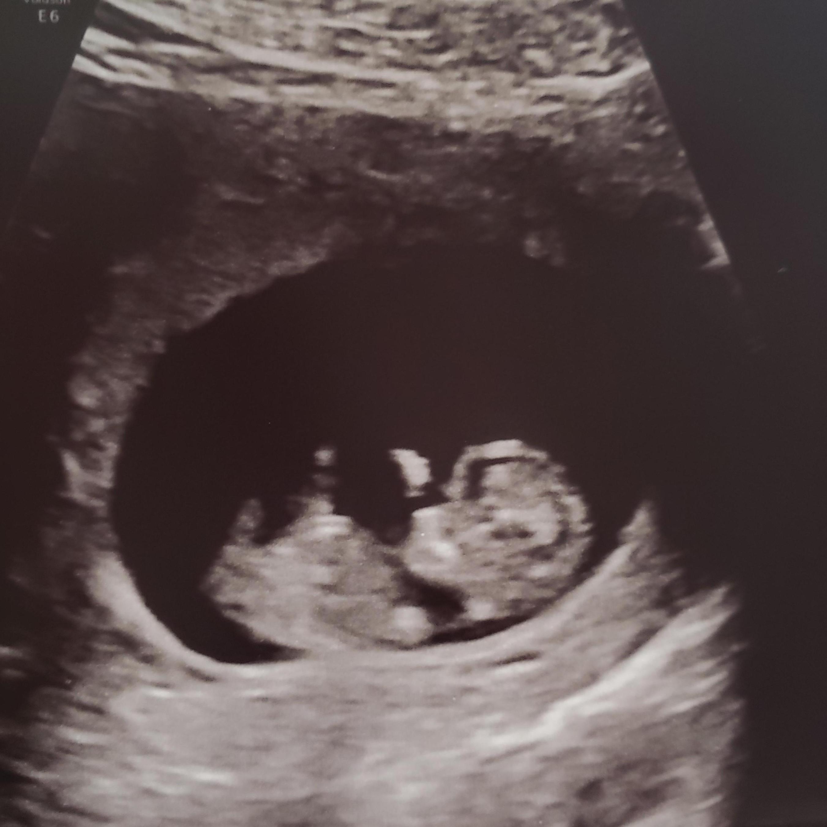 First time seeing our baby. Only 10 weeks old
