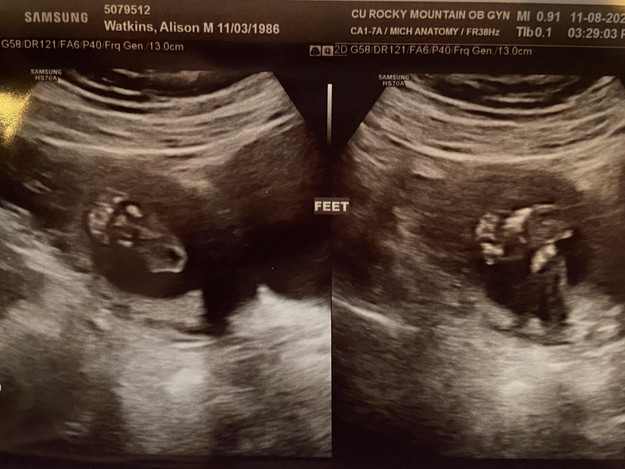 Tiny feet