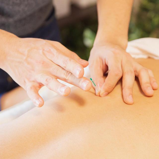 Acupuncture