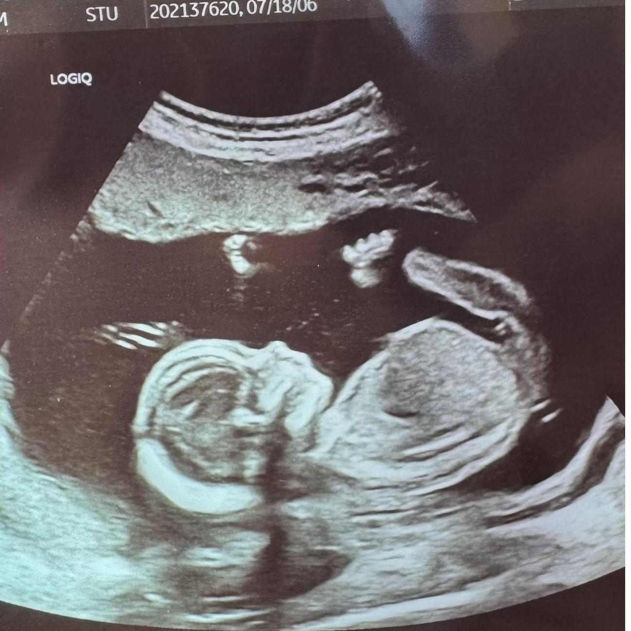 10-12-24 We're PREGNANT