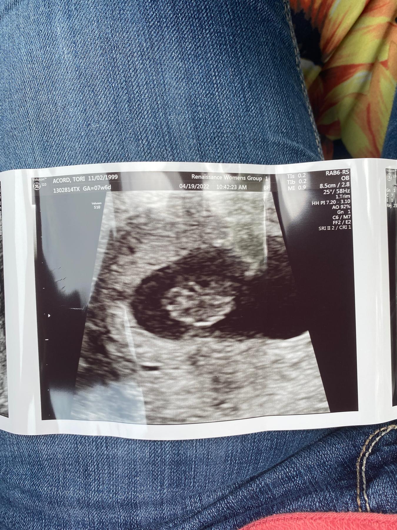 Our first look at baby girl! ❤️