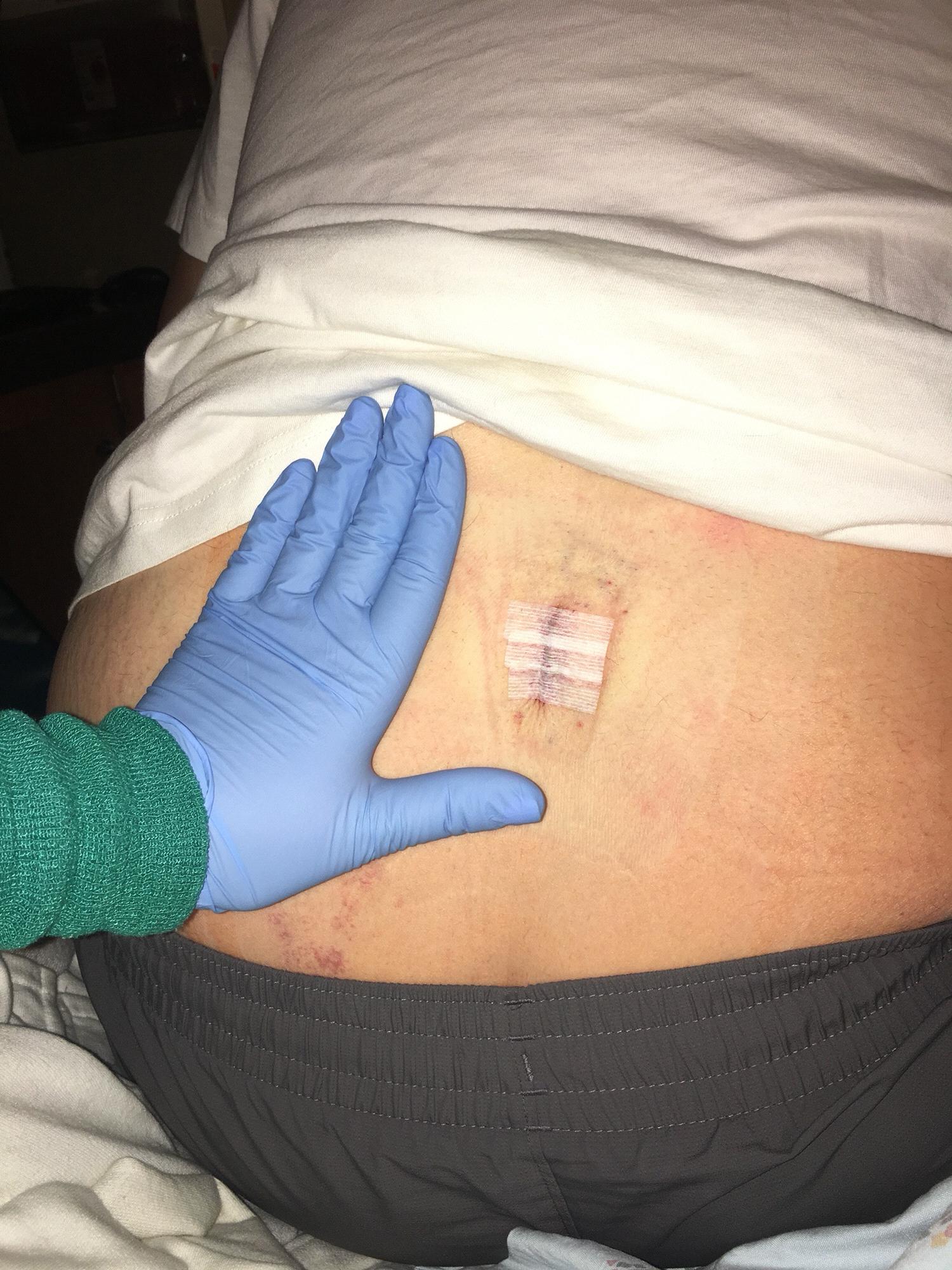 Patrick’s back surgery. 2017
