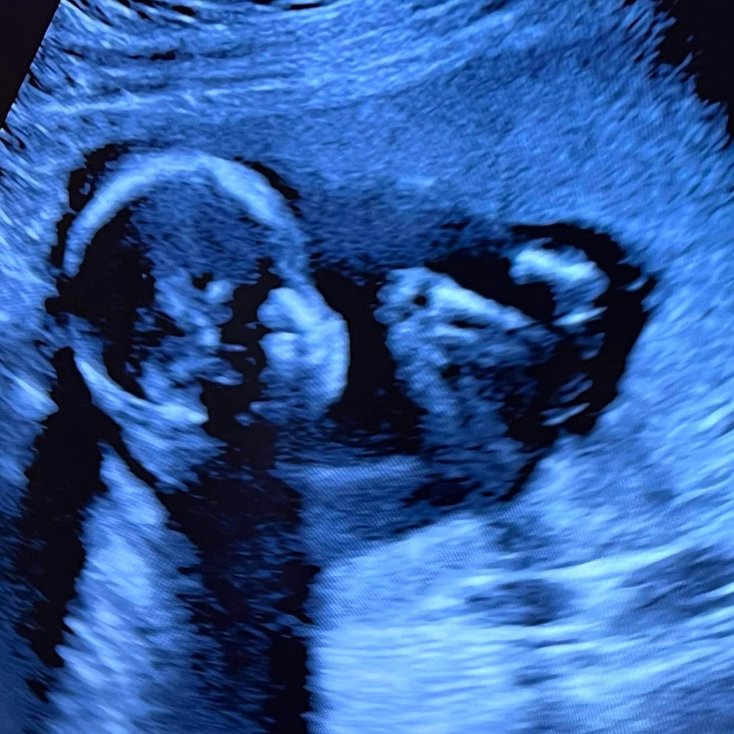 Ultrasound of Robert Ryder Stewart 2022