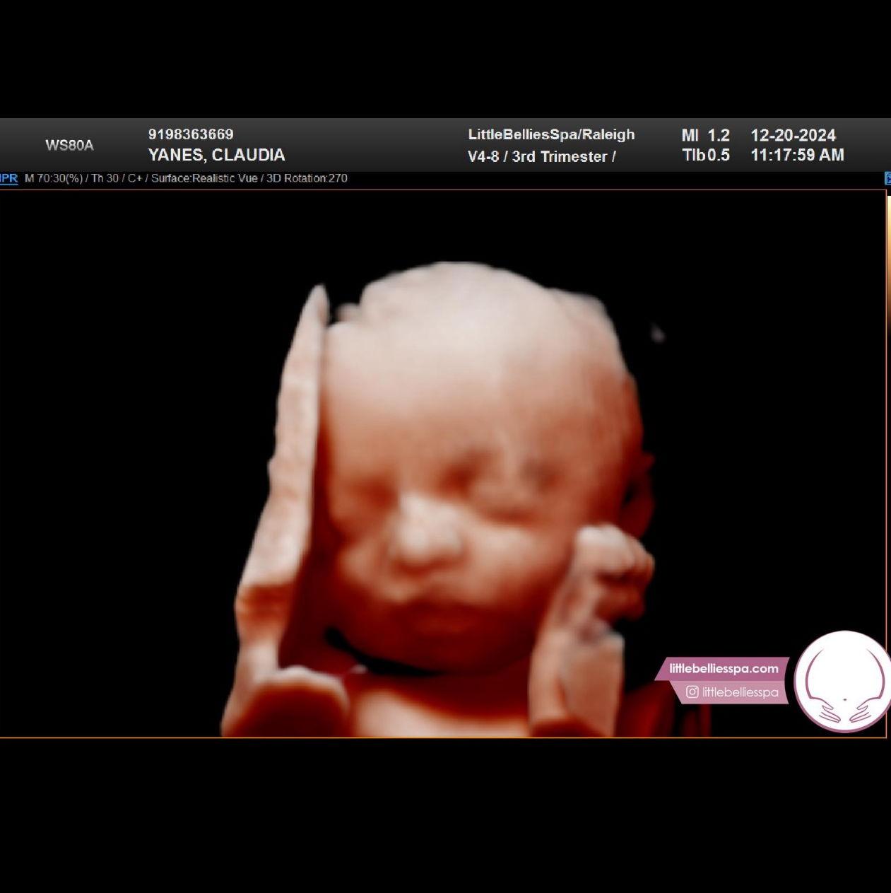 "Our Little Princess" 3D ultrasound