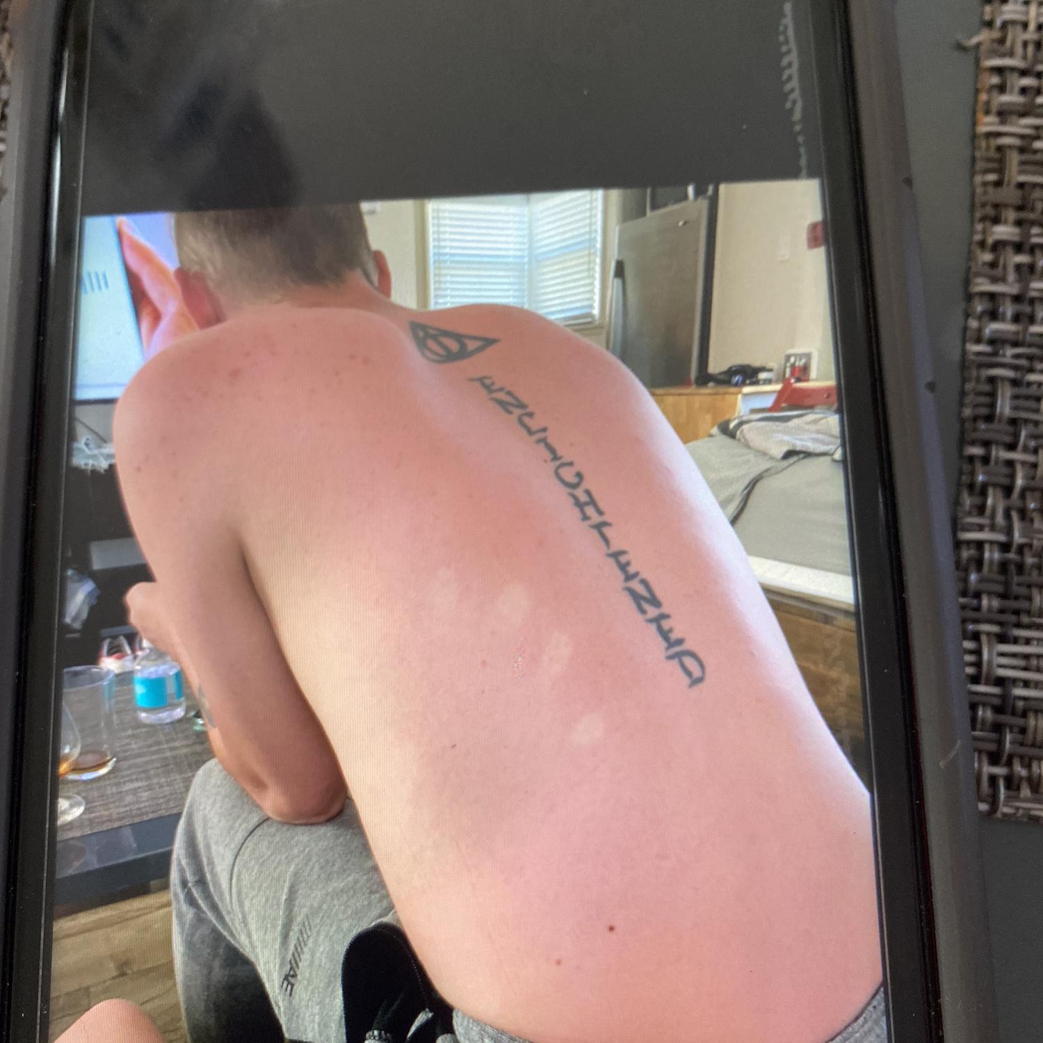 Ouch ! Travis got bad sunburn in California!
