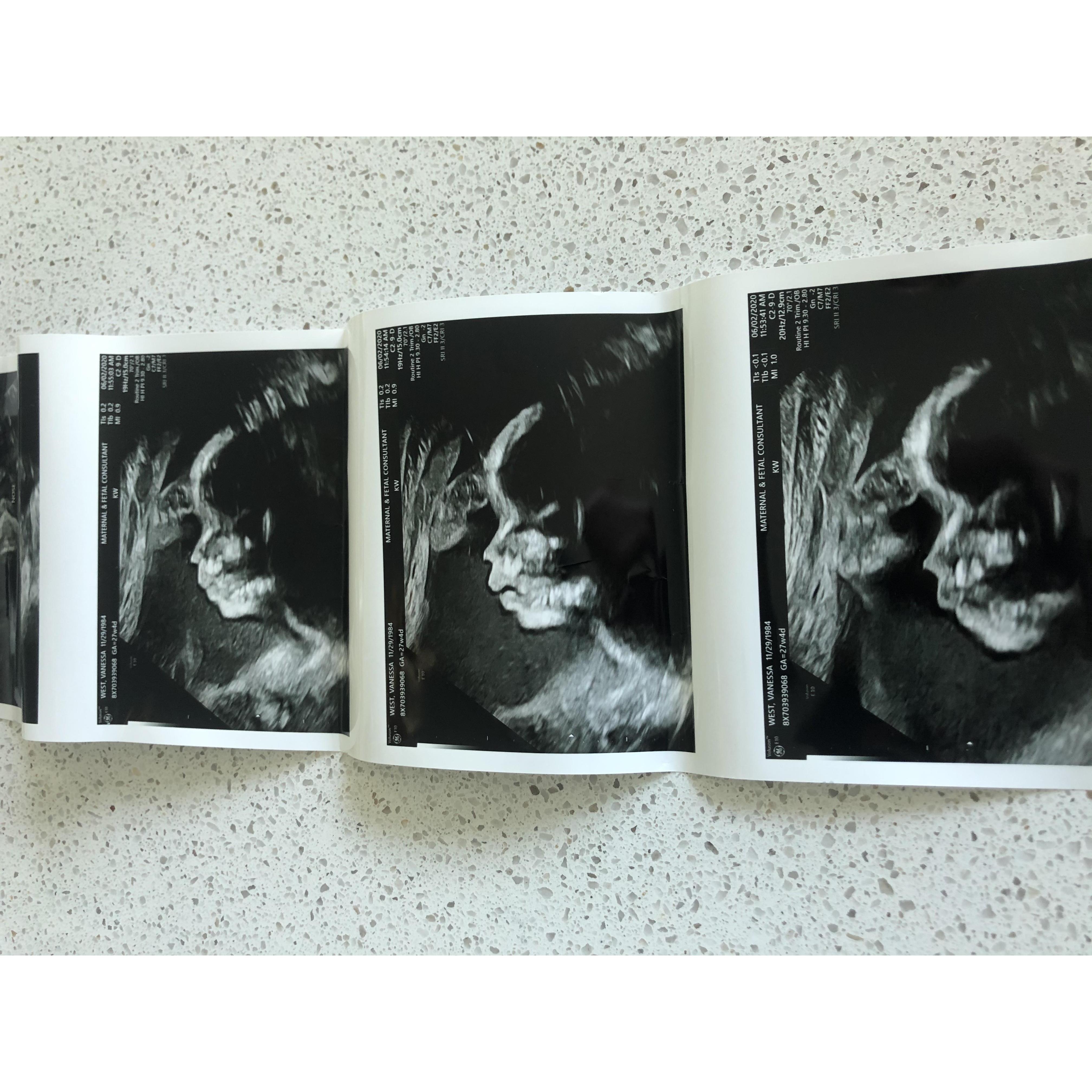 Profile of baby girl at 27 weeks!
