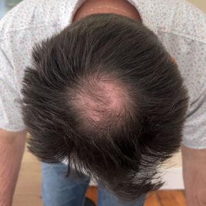 Connor's Hair Plug Fund
