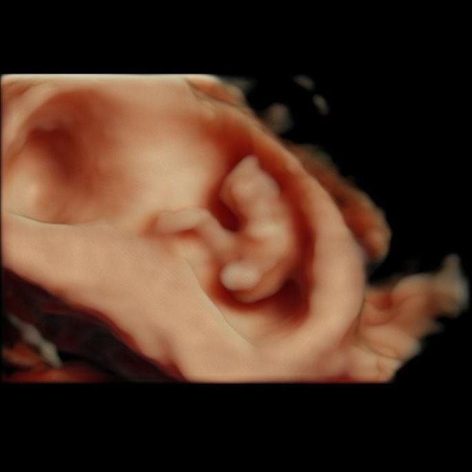 10 week ultrasound